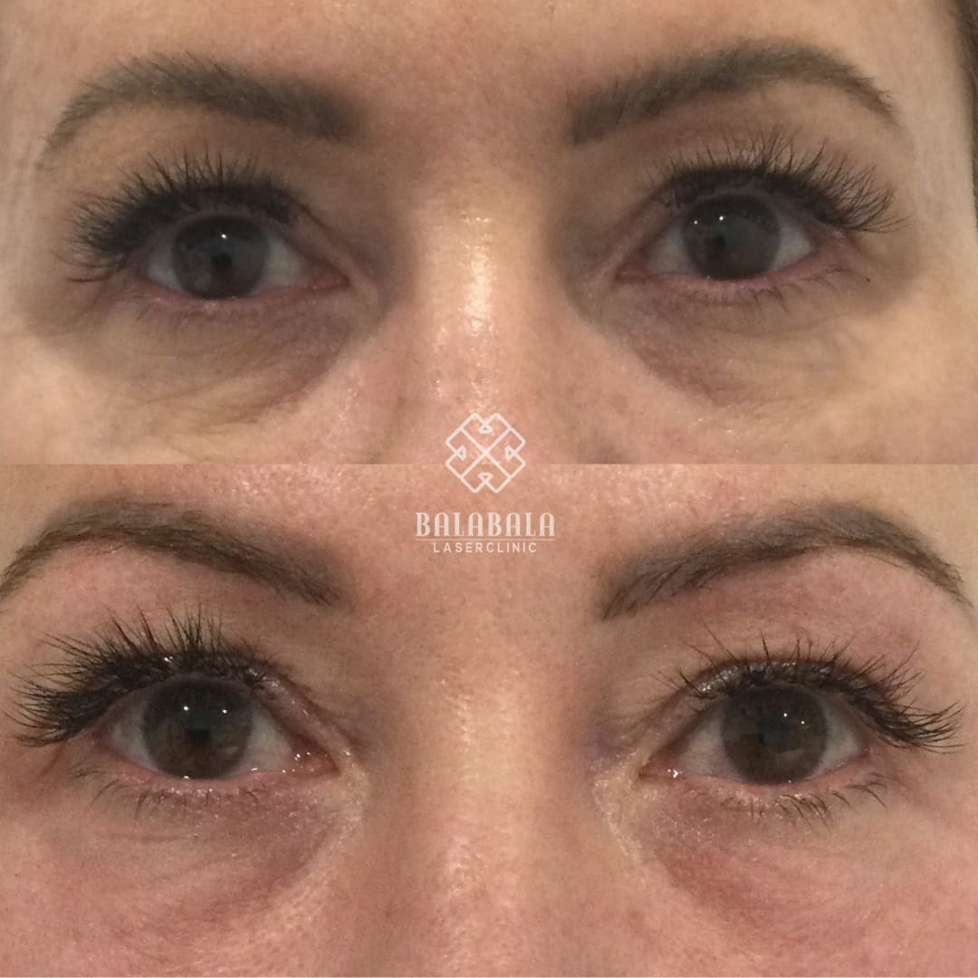 Fotona Smooth Eye Laser Before and After