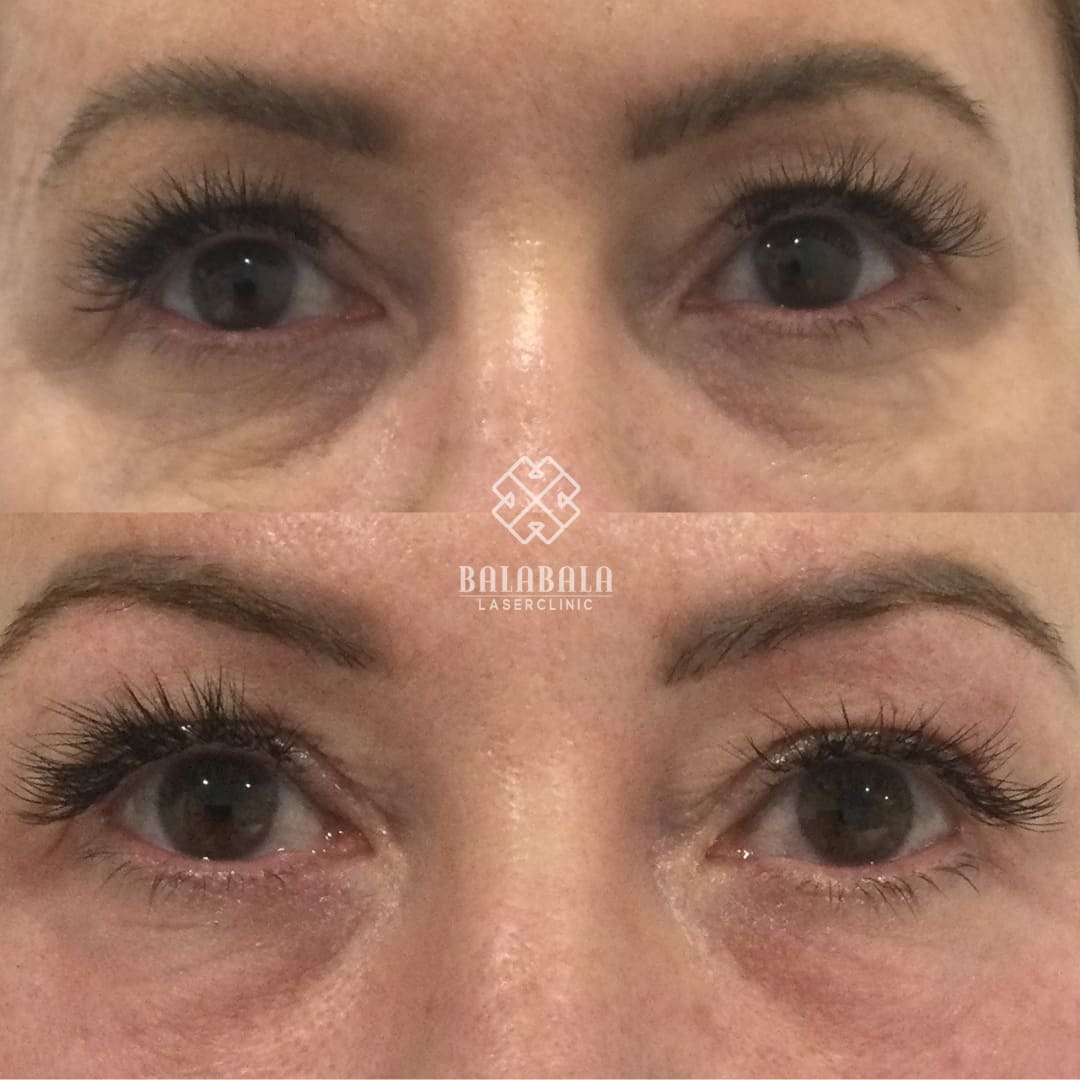 BalaBala Laser Clinc - Fotona Smooth Eye Laser Before and After