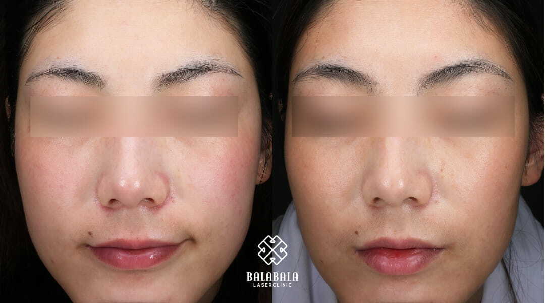 BalaBala Laser Clinc - Icon IPL before and after - skin tone