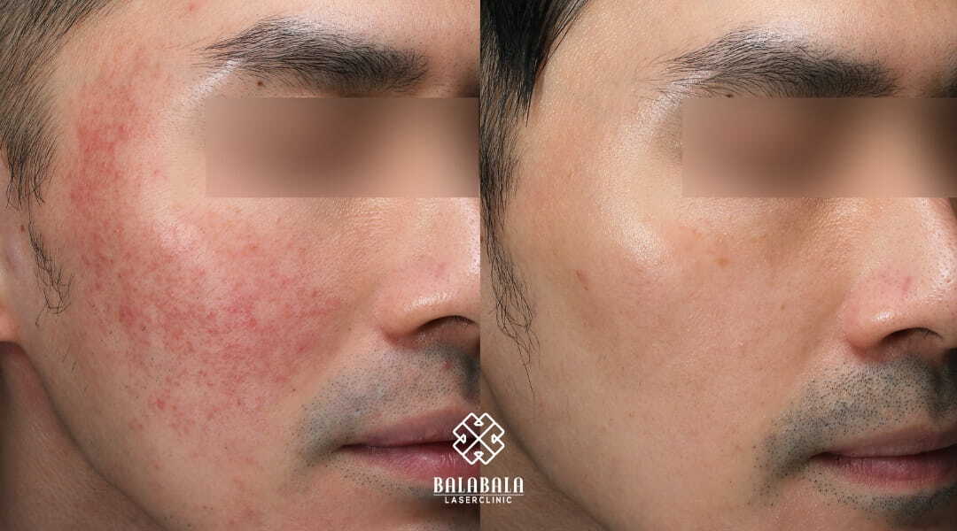 Intense pulsed light 2025 rosacea before after