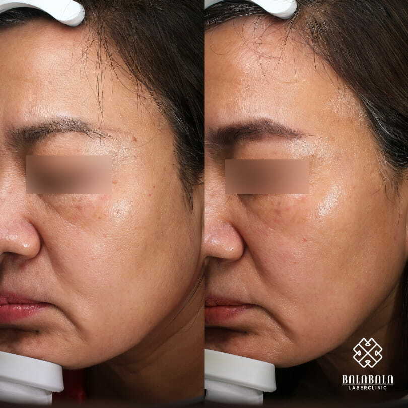 BalaBala Laser Clinc - BCN Mesotherapy for skin lifting