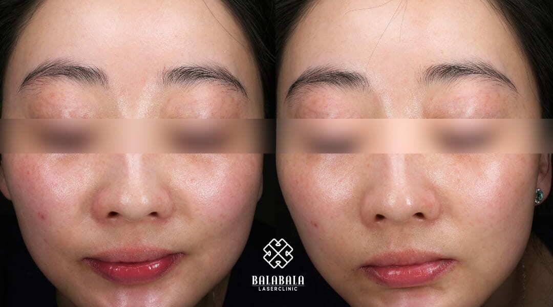 BalaBala Laser Clinc - Mesotherapy before and after skin brightening