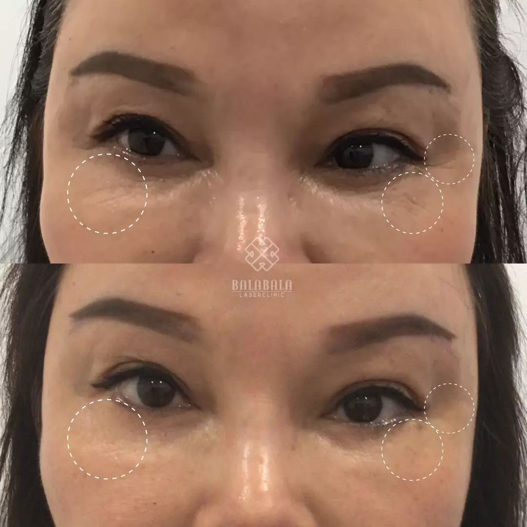 BalaBala Laser Clinc - Before and after, PDO Mono Threads