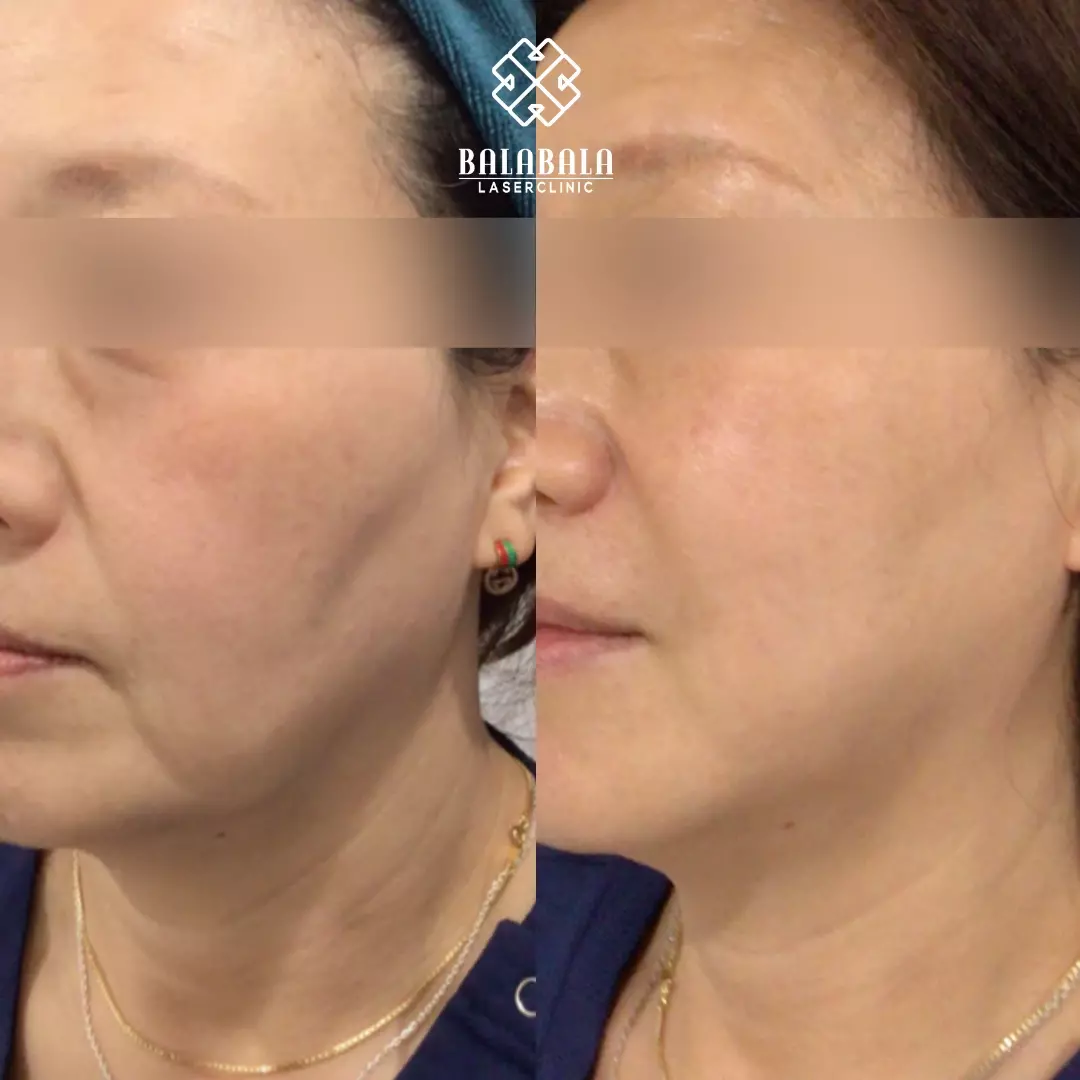 BalaBala Laser Clinc - PDO Mono Threads, Before and After - Face and Eyes