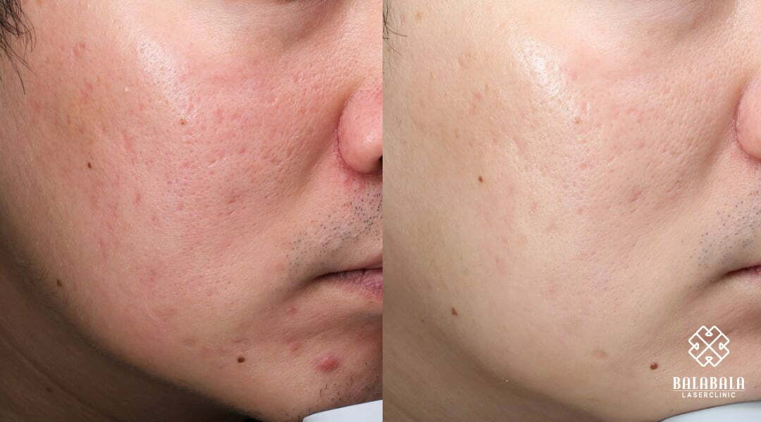 BalaBala Laser Clinc - Chemical peel before and after