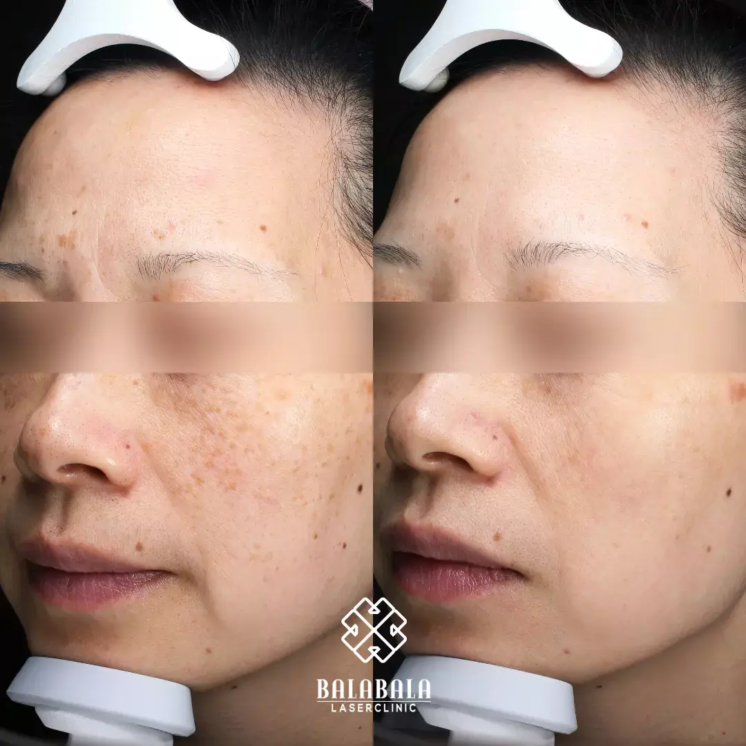 BalaBala Laser Clinc - PicoSure Laser Before and After, Pigmentation Removal