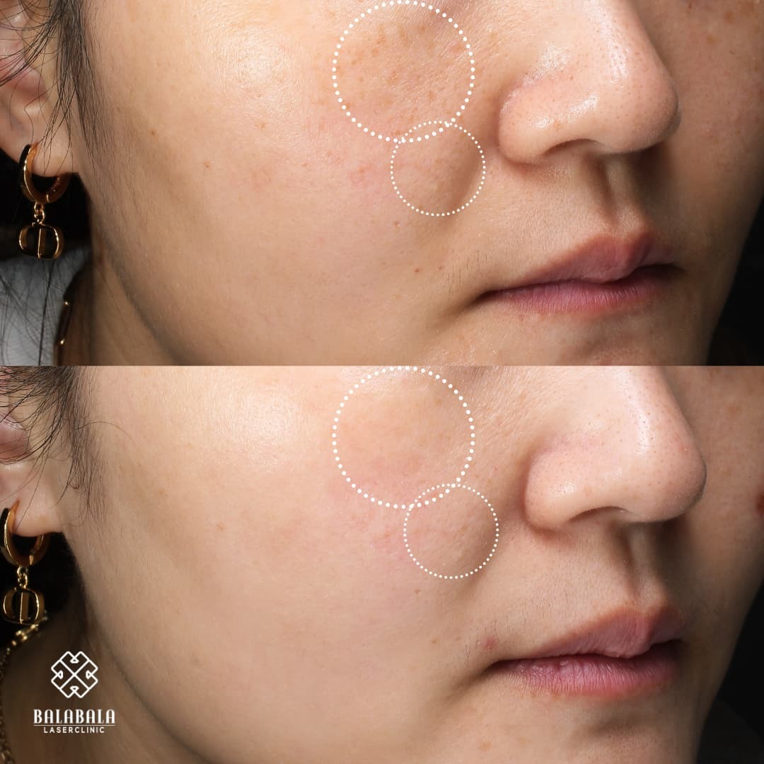 BalaBala Laser Clinc - Picosure Laser Before and After for Pigmentation Removal