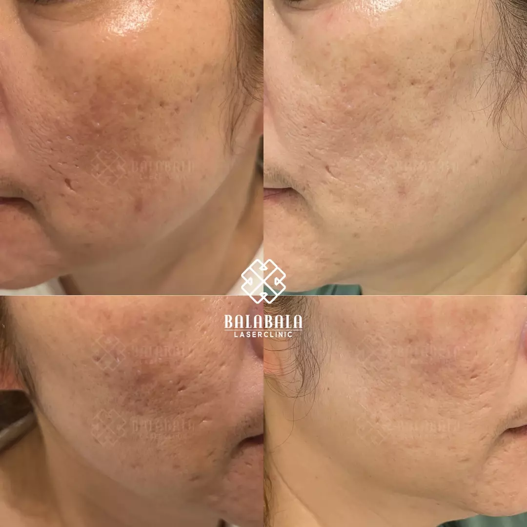 BalaBala Laser Clinc - Rejuran Before and after