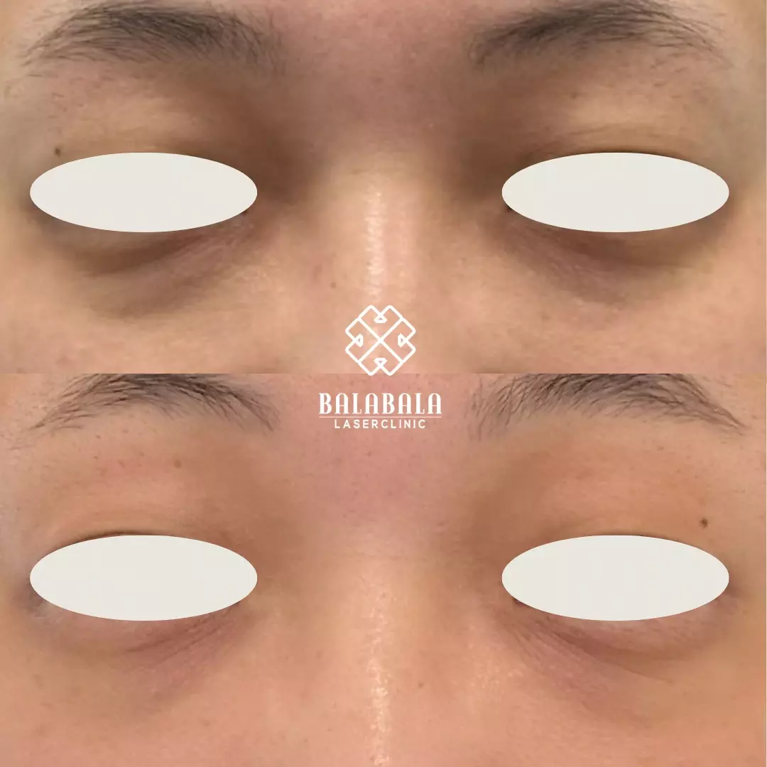 BalaBala Laser Clinc - Rejuran Eye Before and after