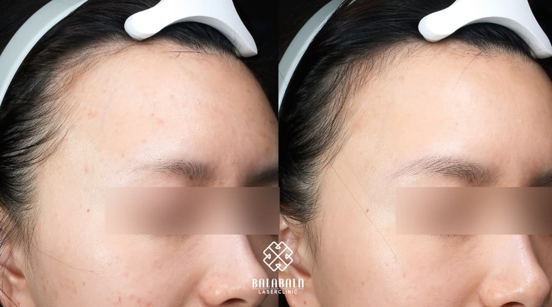 IPL Stellar M22 Perth | BalaBala Laser Clinic