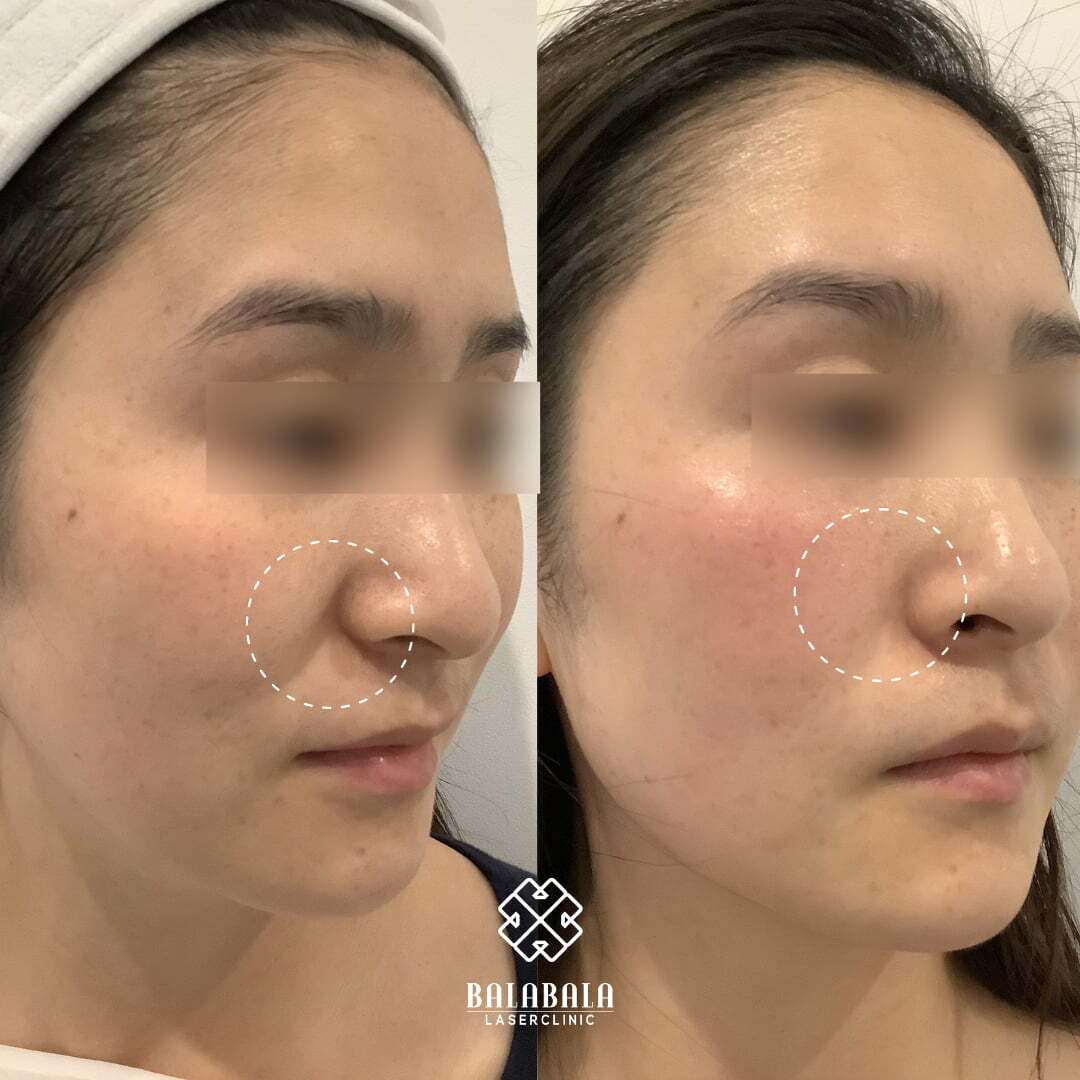 BalaBala Laser Clinc - Thermage FLX Before and After Photo