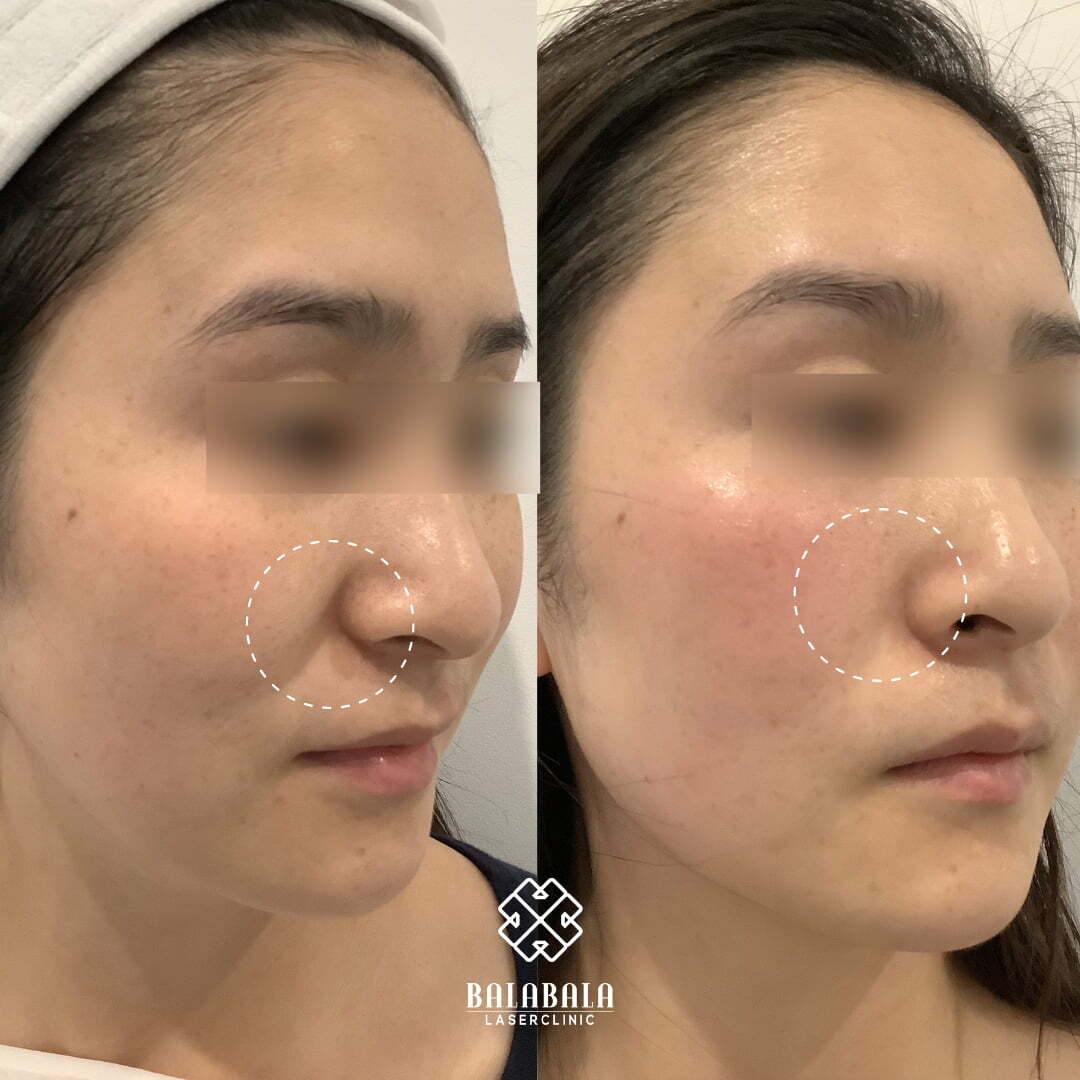 Thermage FLX Skin Tightening - Before and After