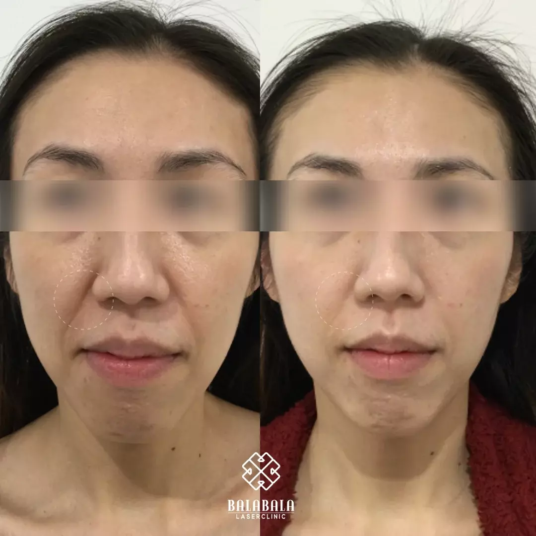 BalaBala Laser Clinc - Thermage FLX before and after skin tightening