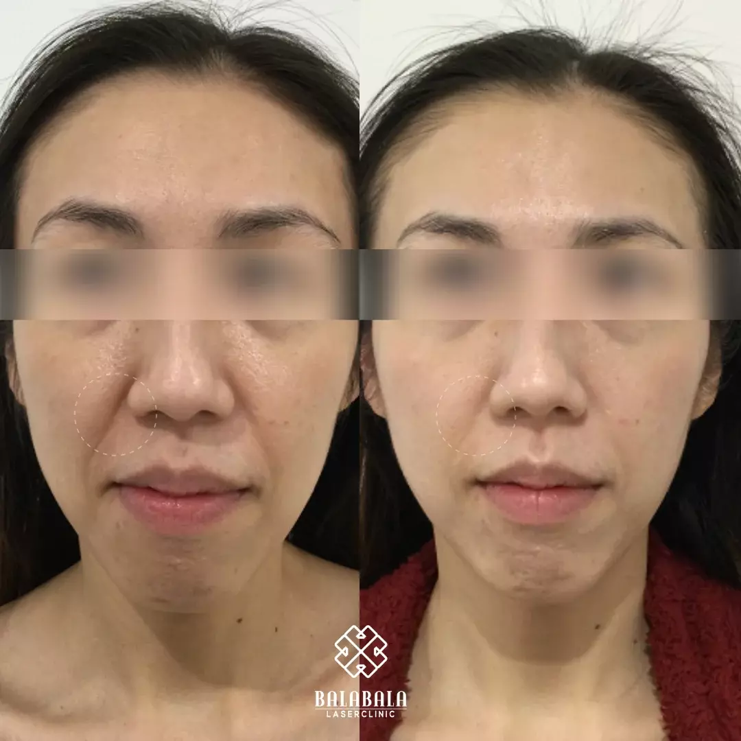 Before & After Photos Subdermal Skin Tightening 3