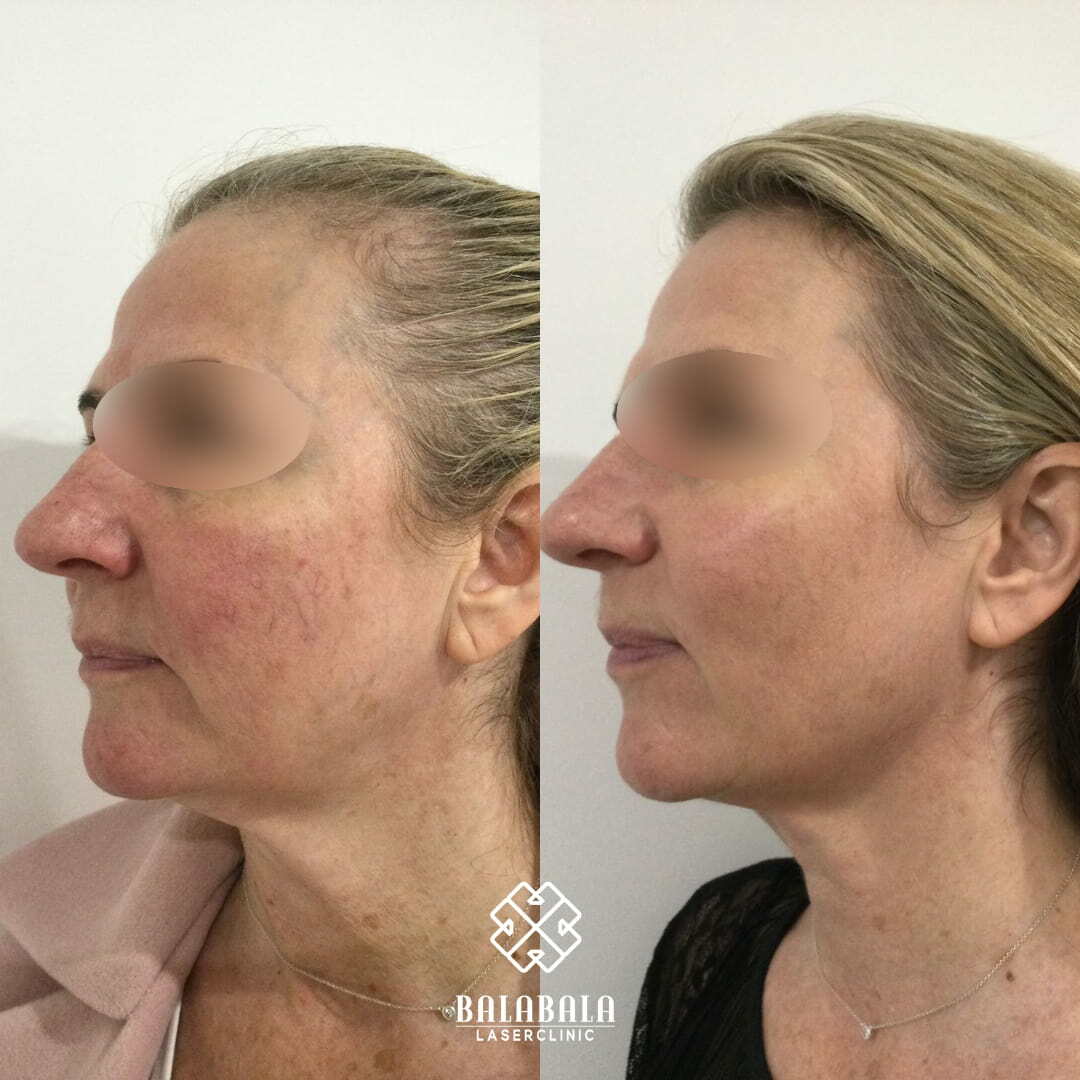 BalaBala Laser Clinc - Ultherapy Face Before and After