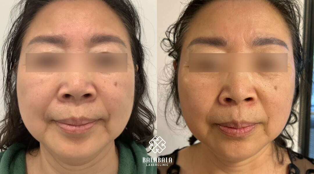 BalaBala Laser Clinc - Ultherapy Jowls Before and After