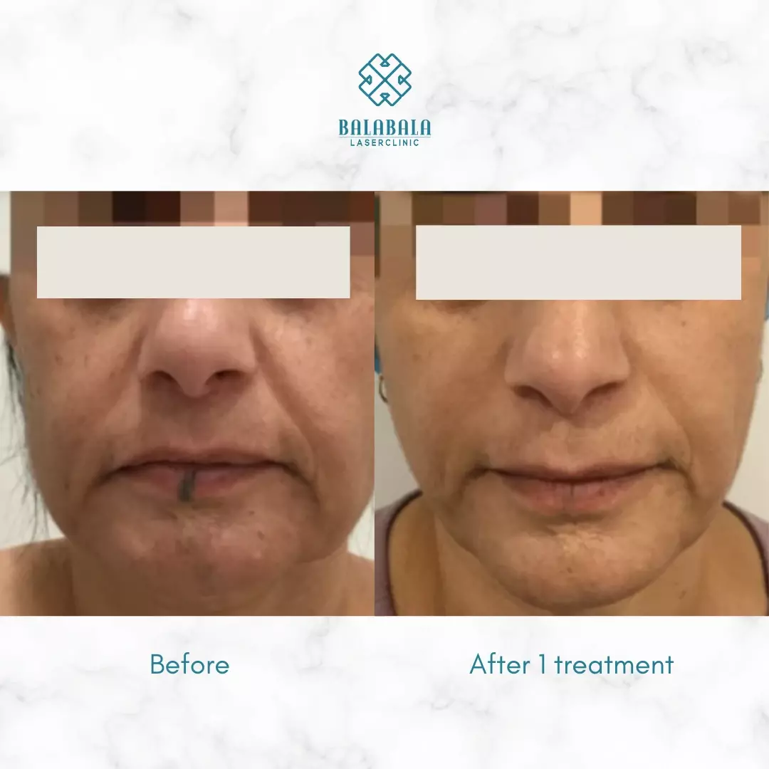 Ultherapy for Sagging Jowls, Before and After