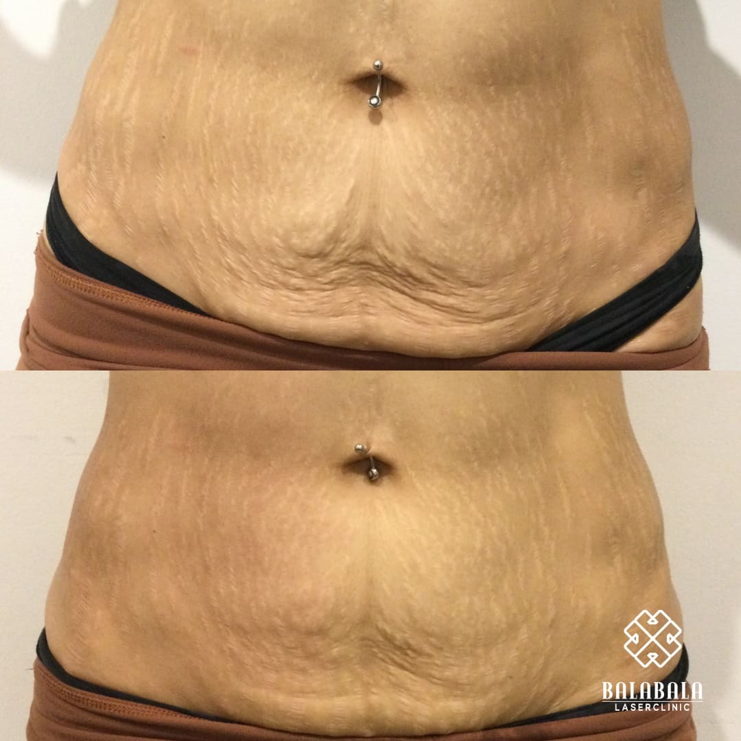 BalaBala Laser Clinc - ULTRAcel Q+ before and after - abdomen tightening