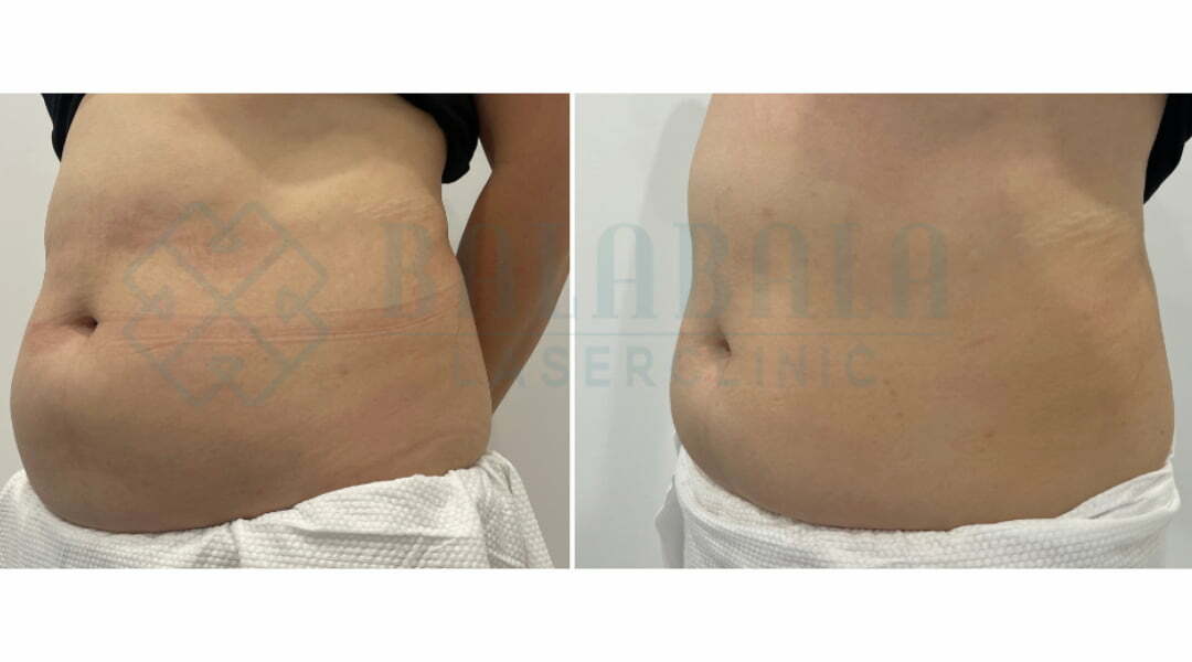 BalaBala Laser Clinc - HIFU Permanent Body Fat Reduction