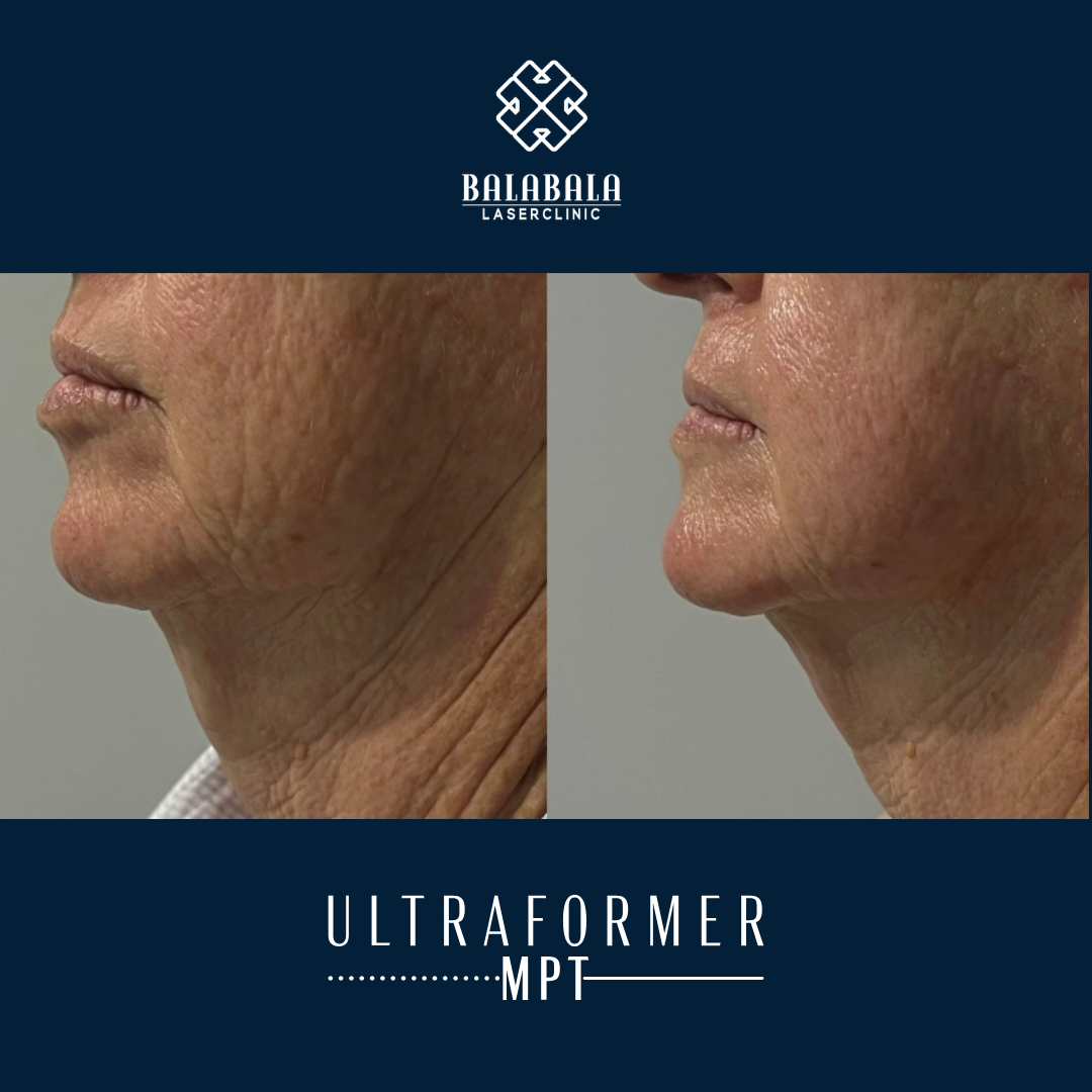 BalaBala Laser Clinc - Ultraformer MPT Before and After, submentum