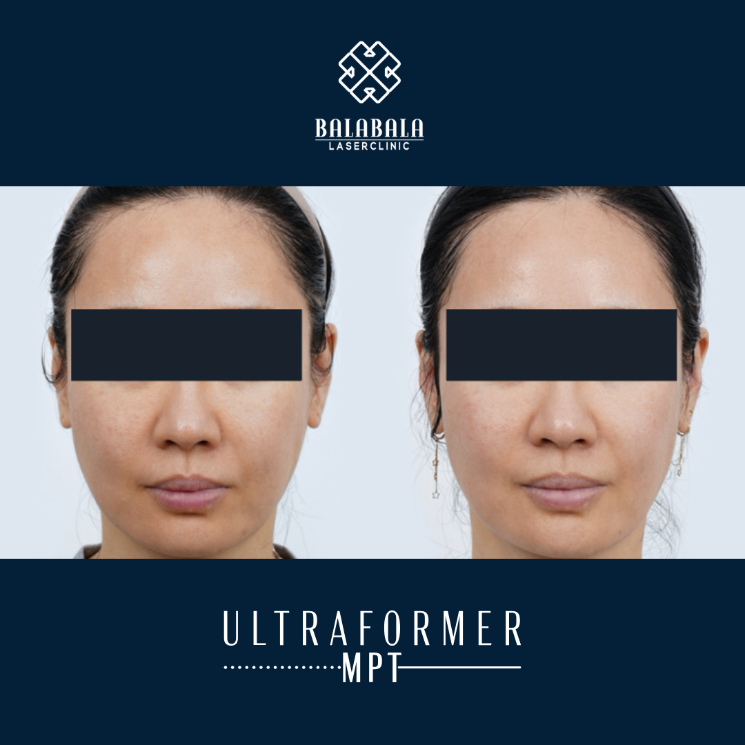 BalaBala Laser Clinc - Ultraformer MPT Before and After