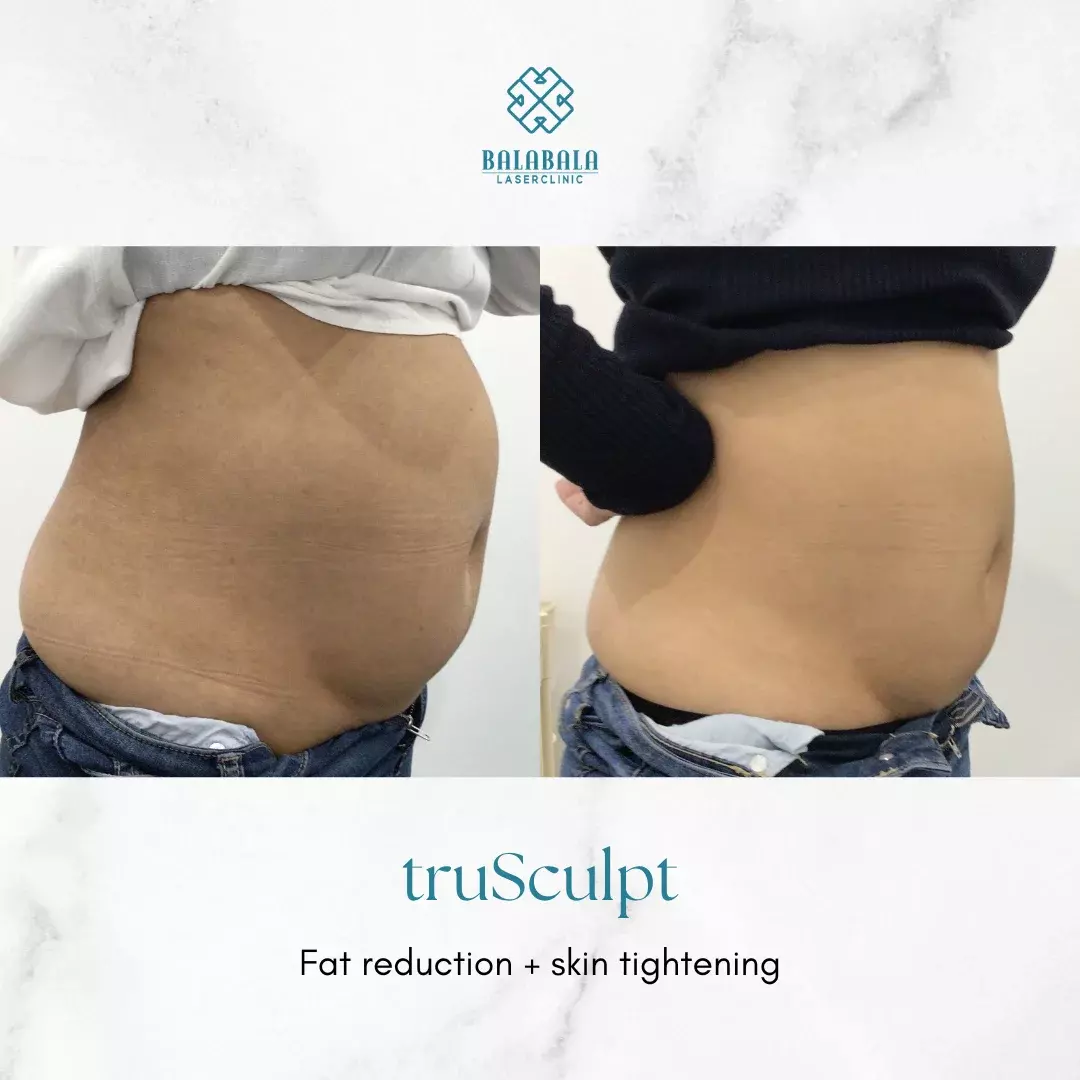 truSculpt®: How Many Body Sculpting Sessions Do I Need
