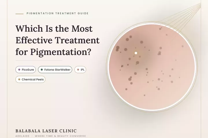 Which treatment is the most Effective treatment for Pigmentation: PicoSure, Fotona StarWalker, IPL or Peels?