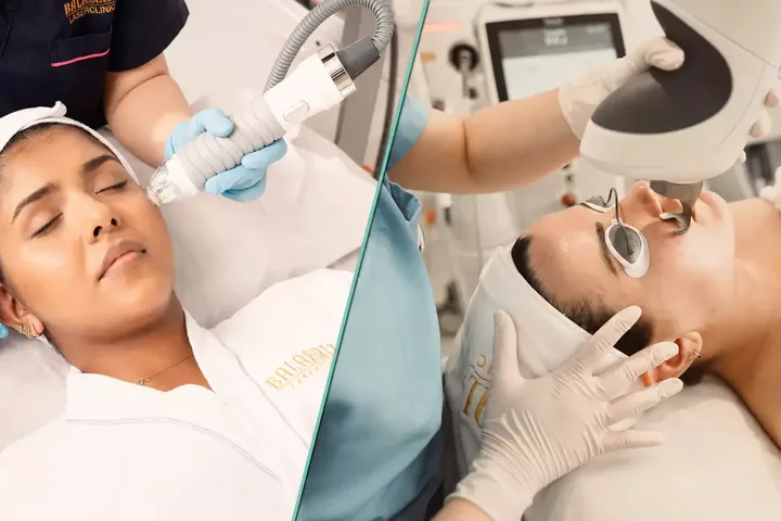 RF Microneedling vs Fractional Laser for Acne Scars: Which Is Better for Your Skin?