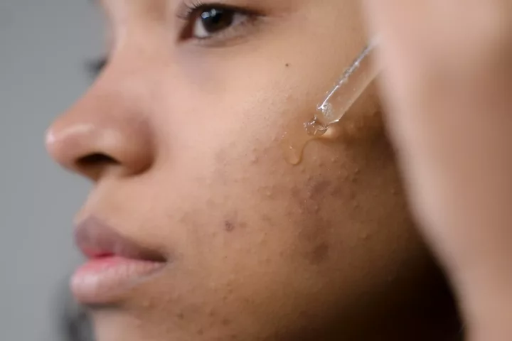 How to treat post-inflammatory hyperpigmentation (PIH)