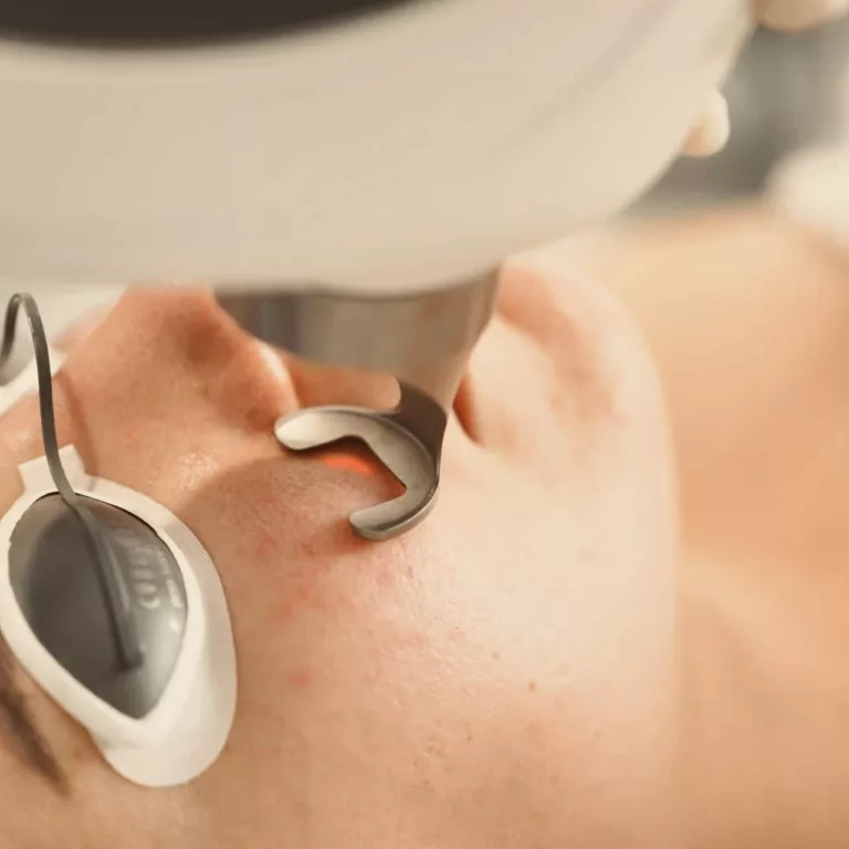 Fotona Angel Skin Brightening