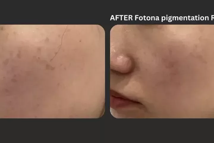 Understanding Types of Pigmentation: Causes, Treatments, and Prevention Tips