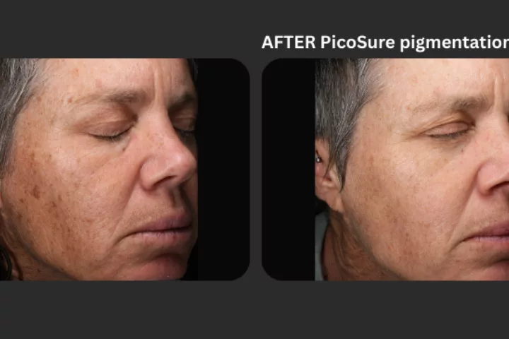 What Is Pico Laser (Expert Guide)