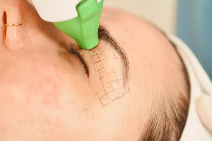 Can I Combine HIFU and Thermage for Enhanced Skin Rejuvenation?