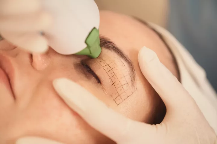 How Long Does Thermage Last For? | Effective Skin Tightening Explained