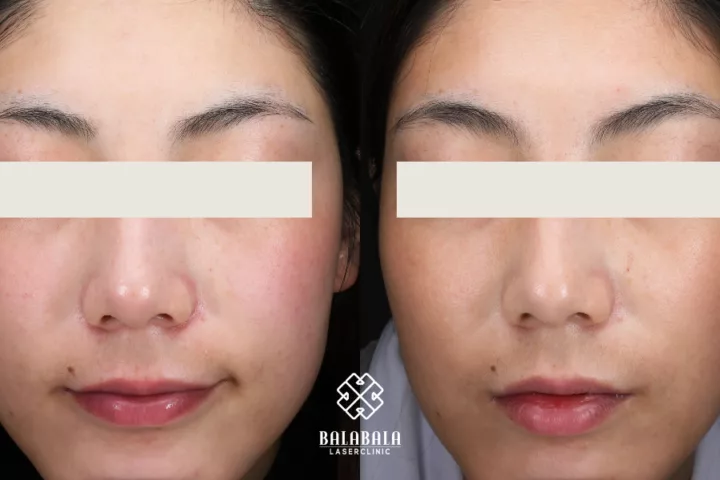 Can You See Results After 1 IPL Session? Discover What to Expect