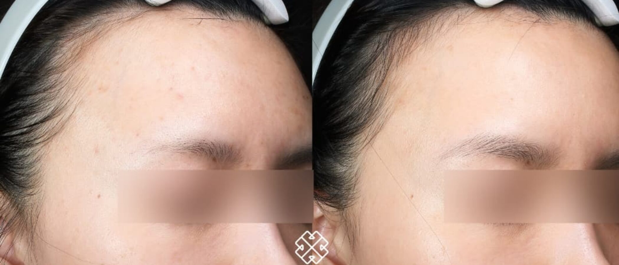 Benefits of M22 Treatment (Advanced Laser Treatment)