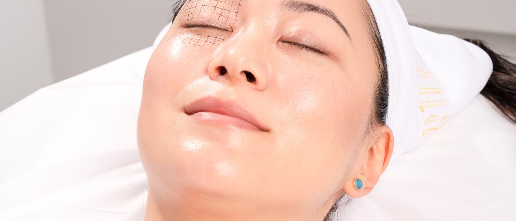 Does Thermage Increase Collagen?