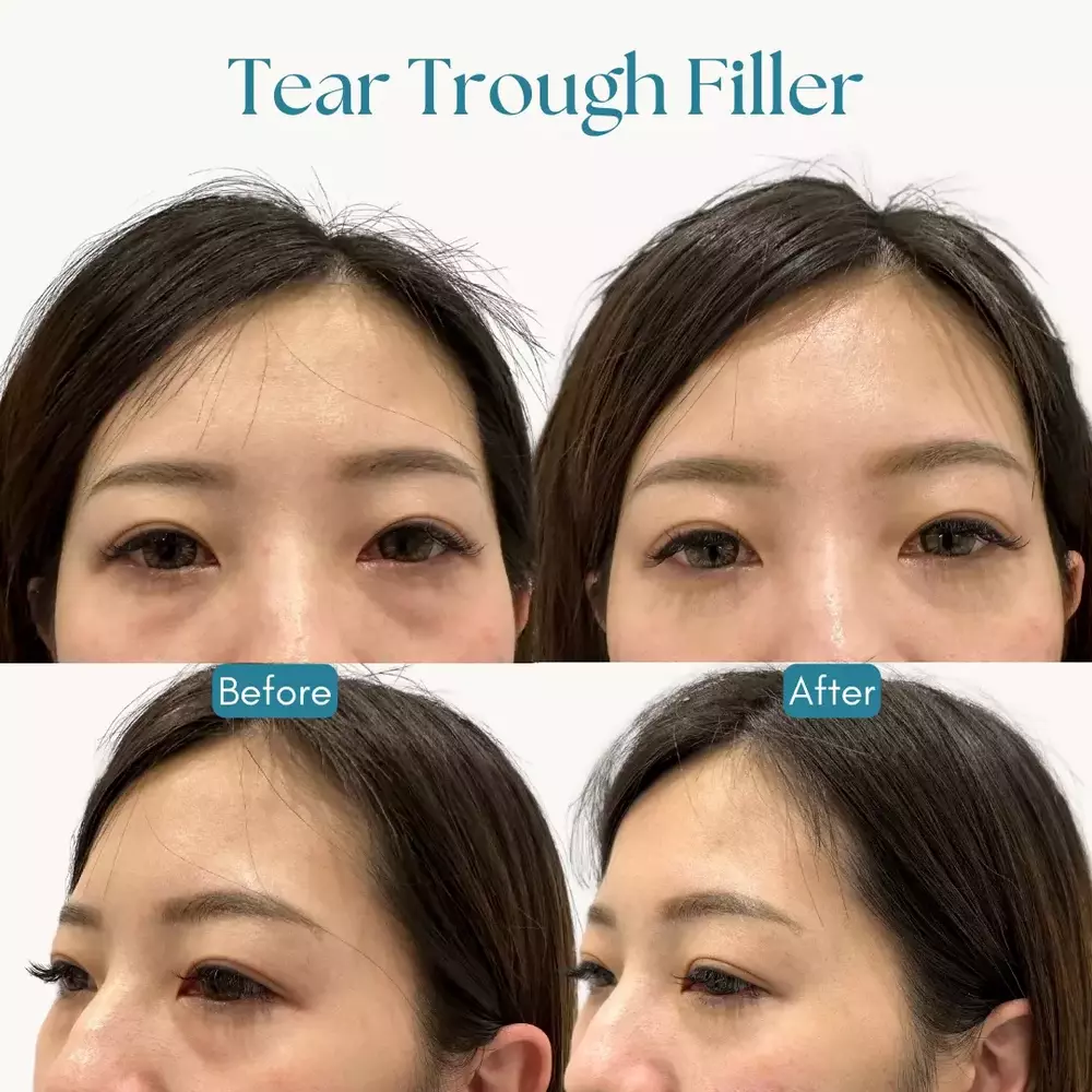 tear trough dermal filler, before and after