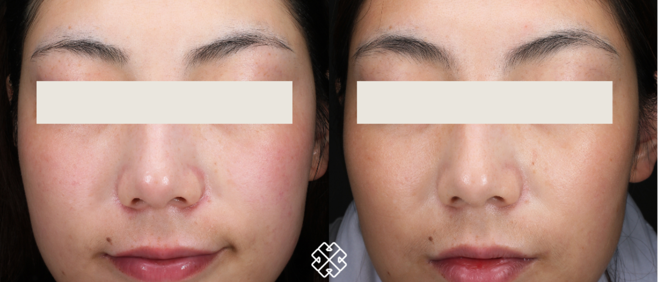 Can You See Results After 1 IPL Session? Discover What to Expect