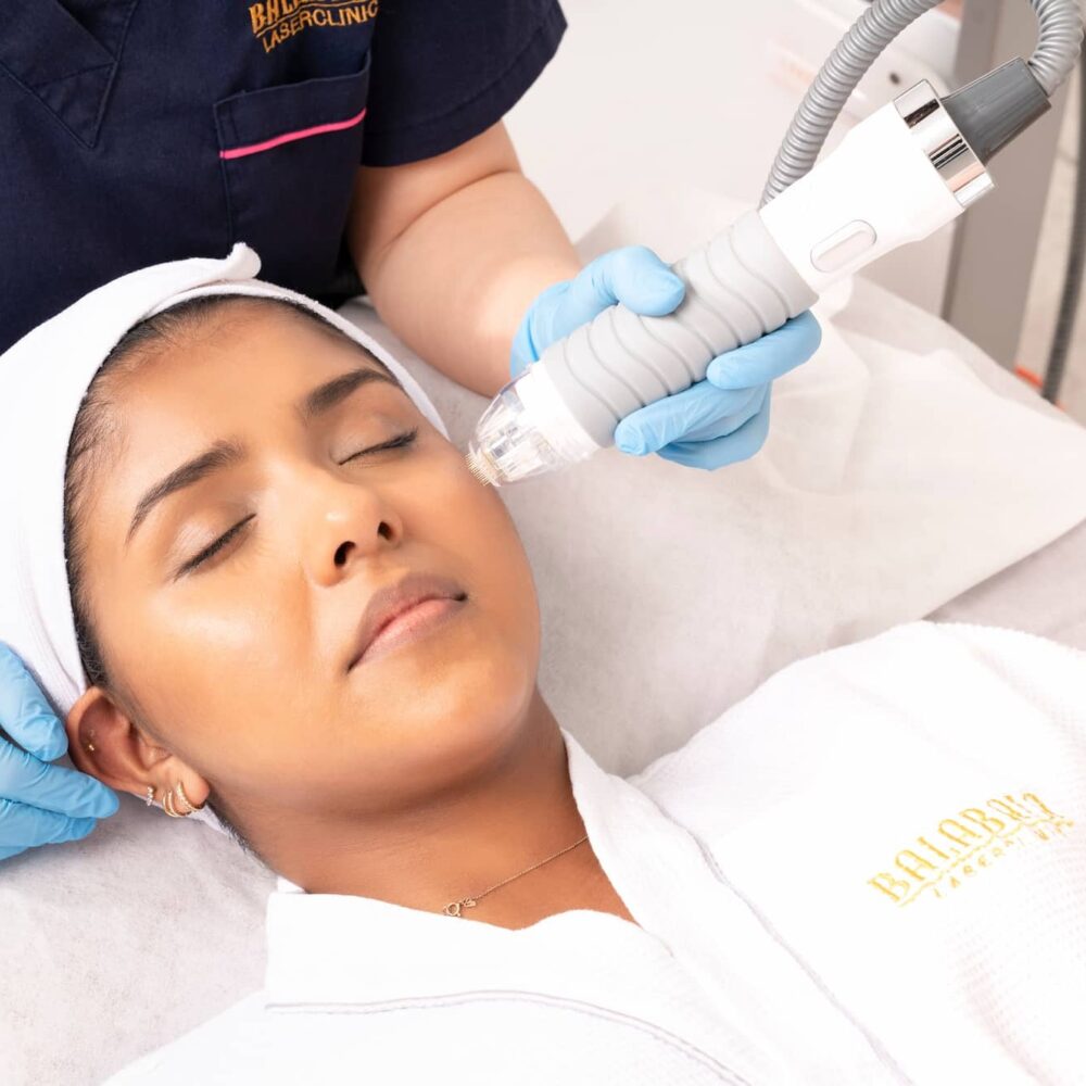 Vivace RF Microneedling Adelaide