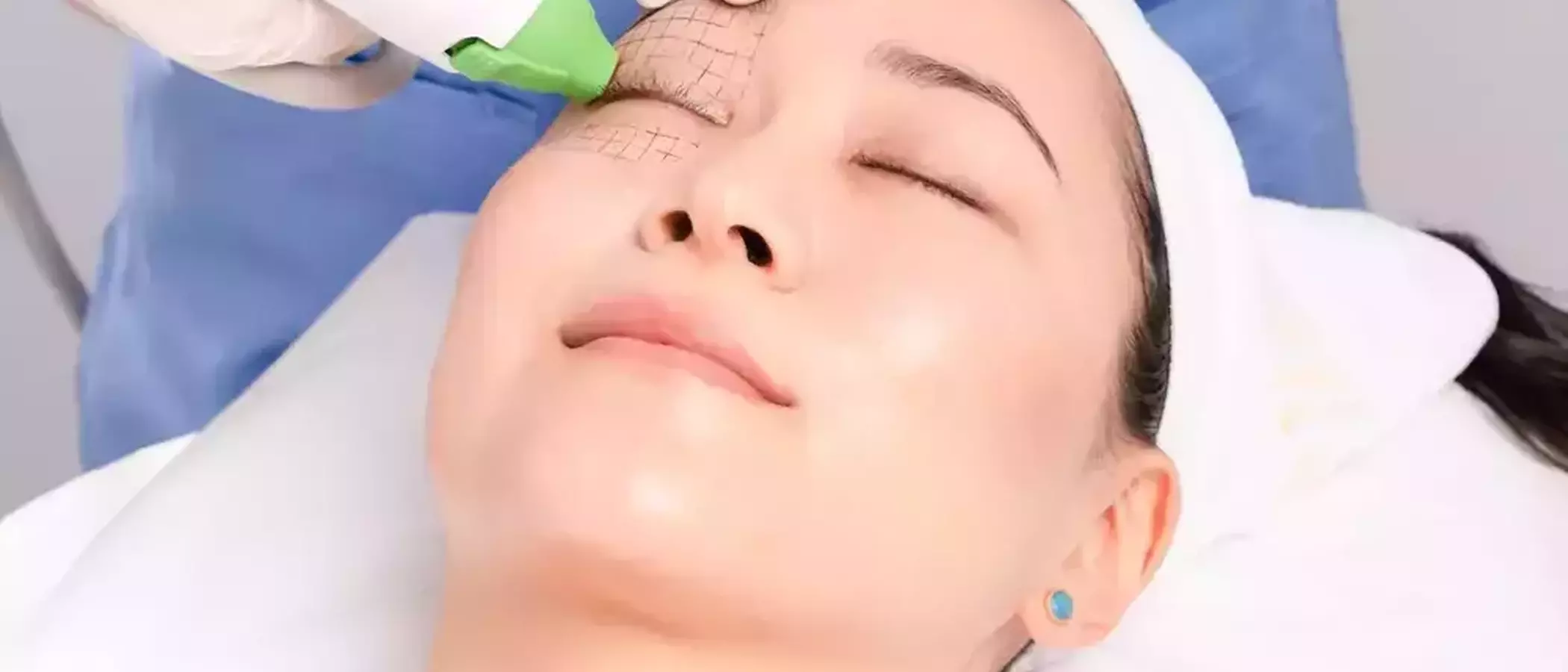 What Is Thermage? Revolutionary Skin Tightening Treatment