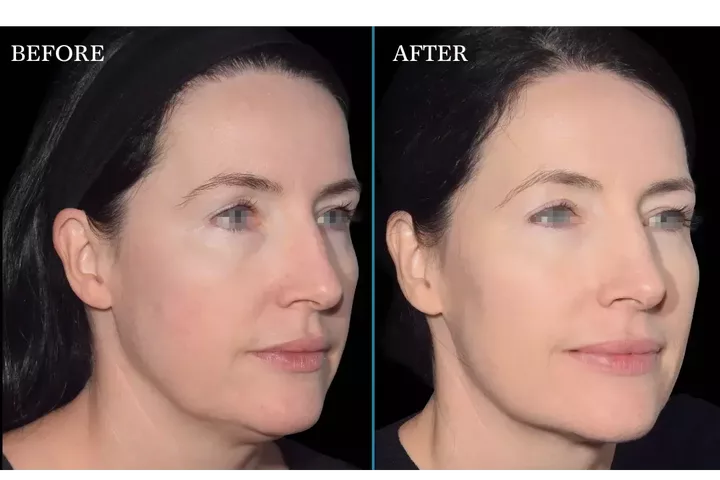 Emface vs Thermage (Treatment Comparison)
