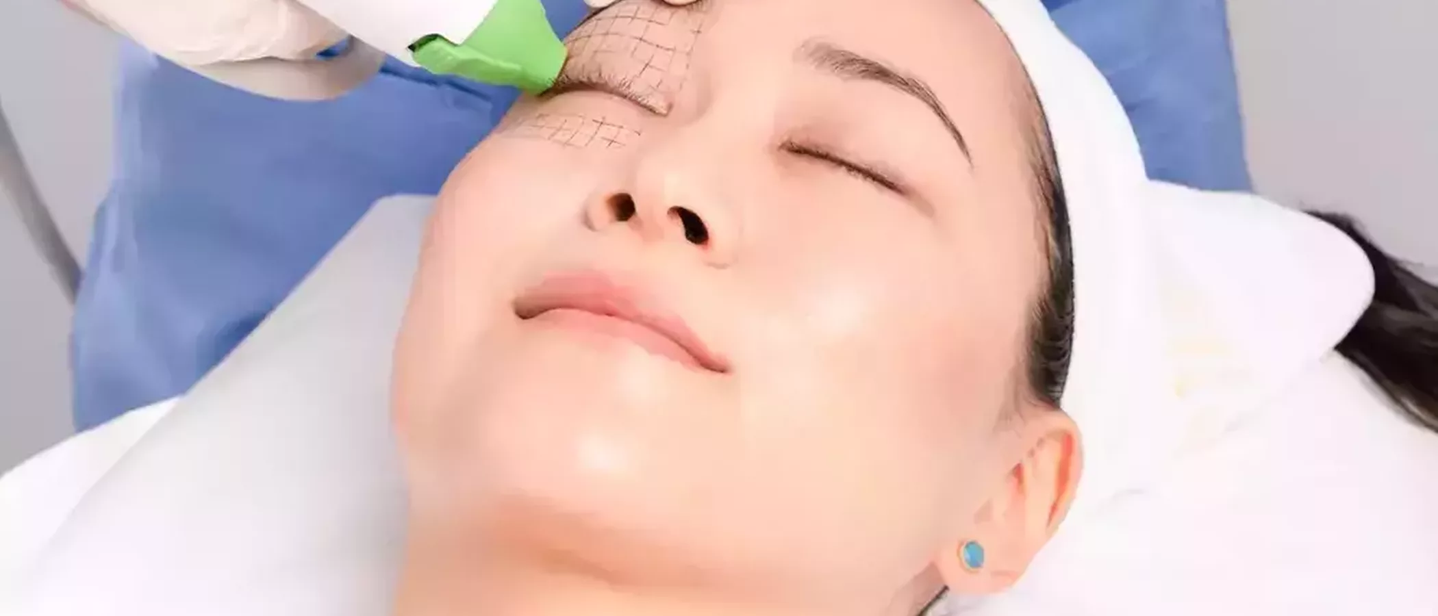 Can I Combine HIFU and Thermage for Enhanced Skin Rejuvenation?