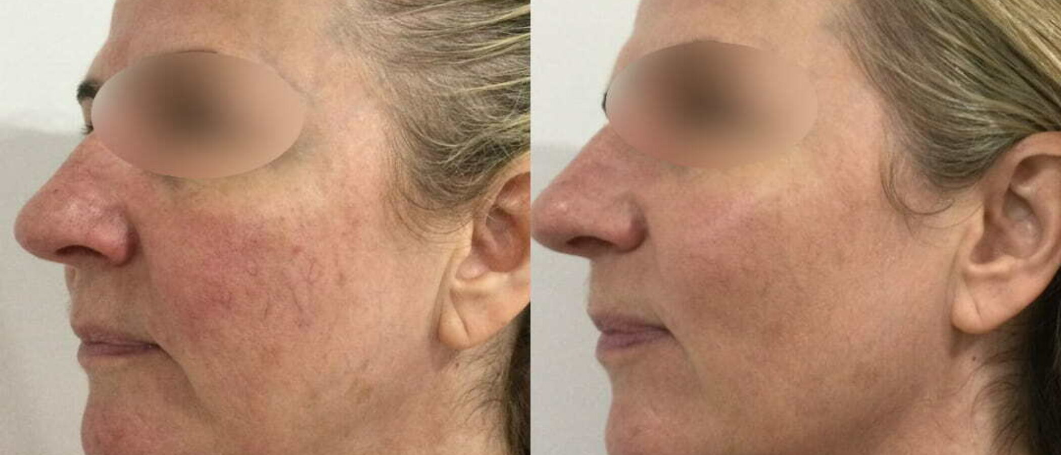 What Is Ultherapy? Ultimate Guide to Non-Surgical Skin Lifting