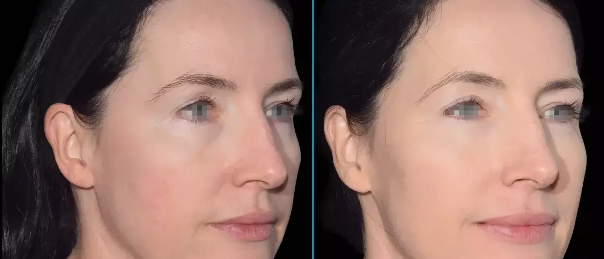 Emface vs Thermage (Treatment Comparison)